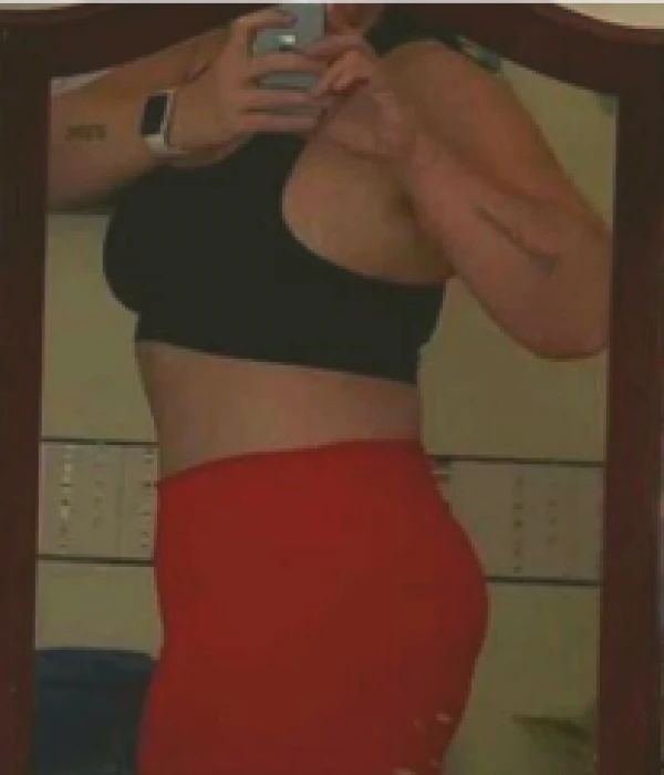 liposuction-after3