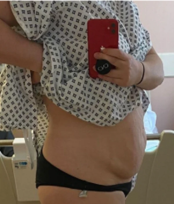 liposuction-before3